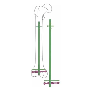 Distal-Femoral-Nail