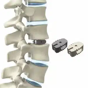 Lumbar-Cage-PLIF