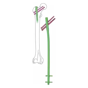 Proximal-Femoral-Interlocking-Nail