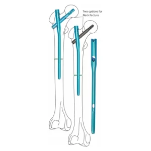 Proximal-Femoral-Nail-Antirotation-130°